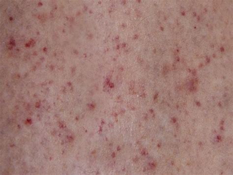 purple rash meningitis